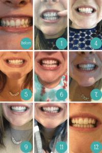 My Smile Direct Club results after 6 months of wearing invisible aligners!