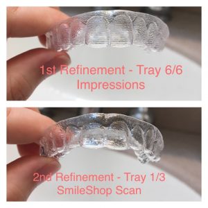 Aligner differences from 1st and 2nd rounds with Smile Direct Club.