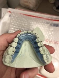 Lower teeth Hawley retainer on the plaster molds of my teeth.