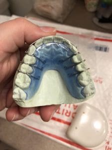 Hawley retainer top teeth