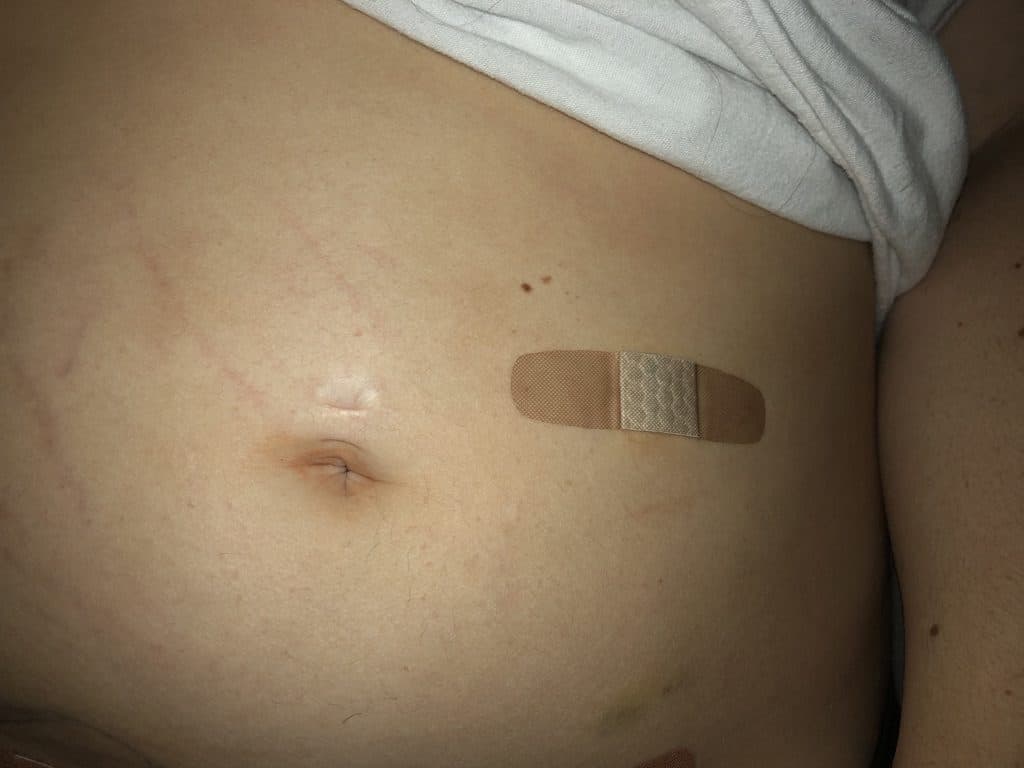 Bandaged area after my appendicitis and appendectomy.